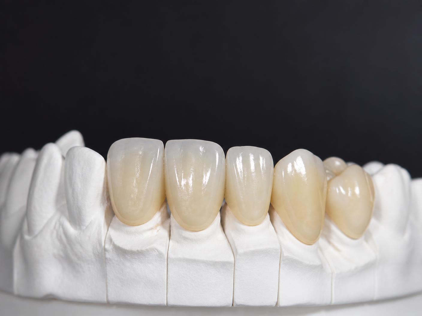 Restauraciones de porcelana dental sobre modelo de yeso
